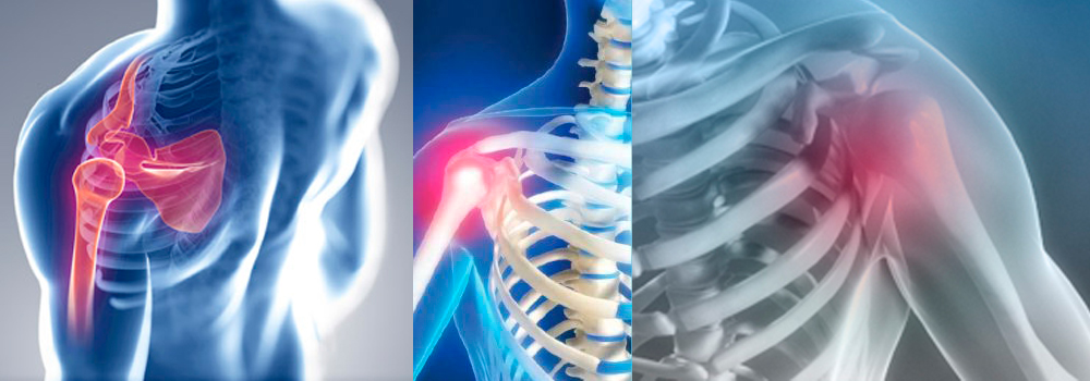 Luxação de Ombro e Cotovelo