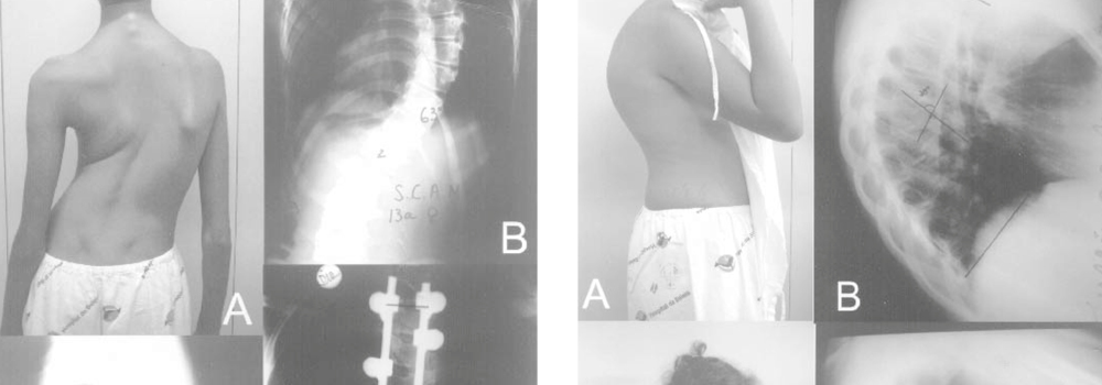 Sistema de parafusos pediculares no tratamento de deformidades vertebrais: análise da correção e das complicações imediatas